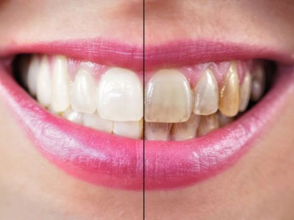 Remove Guthka stain from teeth