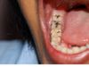 Teeth Cavity Problem