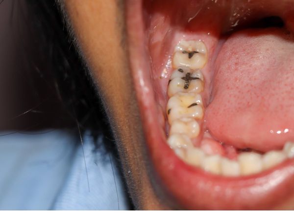Teeth Cavity Problem