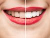 Tips to Get White Teeth