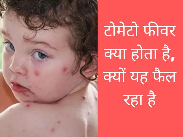 What is Tomato fever, why it is spreading, how to prevent Tomato fever