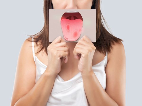 Home Remedies How To get Rid of Sore Tongue
