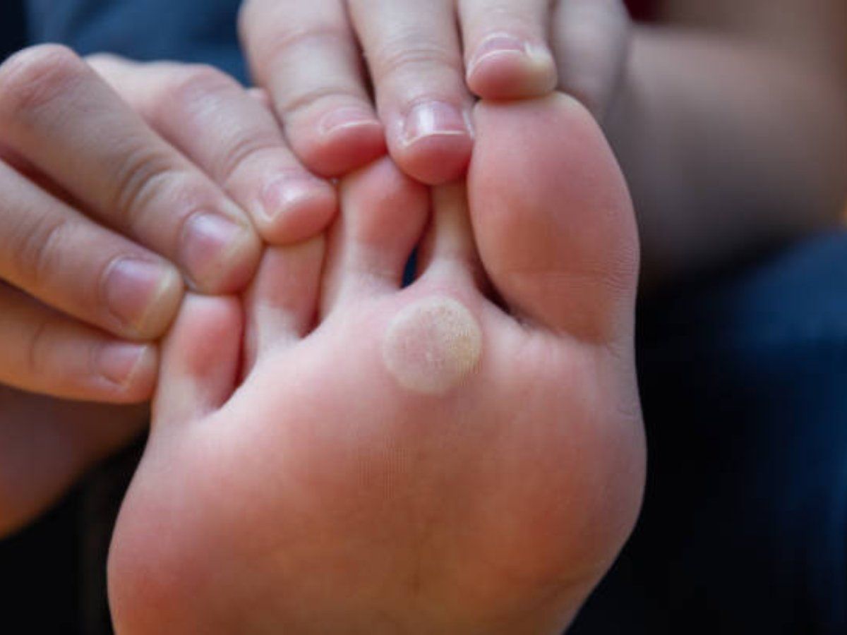 Corns on Feet Treatment of Corns in Feet हाथोंपैरों में हो गई हैं