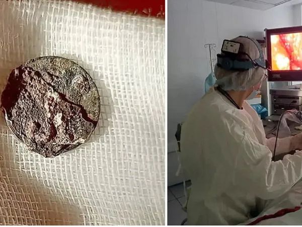 नाक में सिक्‍का डाल भूल गया शख्‍स, 50 साल बाद सांस लेने में हुई तकलीफ, करना पड़ा ऑपरेशन