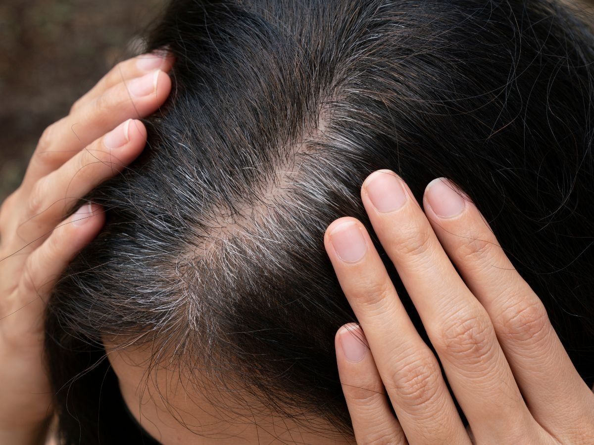 What Causes White Hair at Early Age  Remedies for It