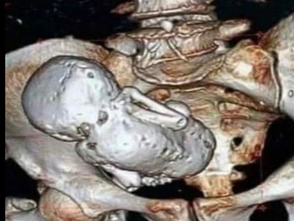 stone baby fetus found in womb of elderly woman who complained of stomach pain