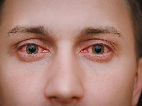 Five home remedies to prevent eye infections 