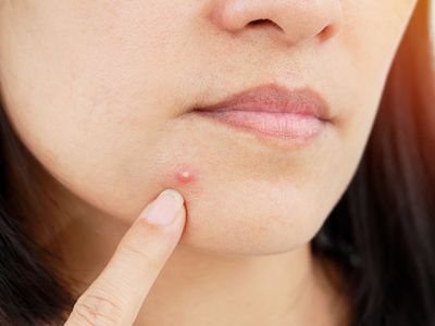 pimples problem pimples problem